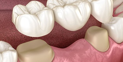 Illustration of traditional dental bridge for lower dental arch