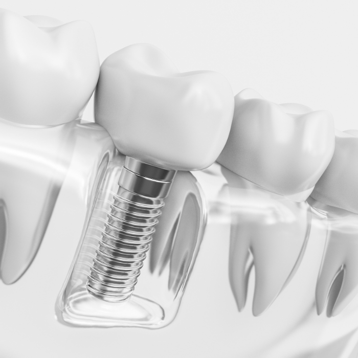 Animated model of jaw with a dental implant in Grand Prairie