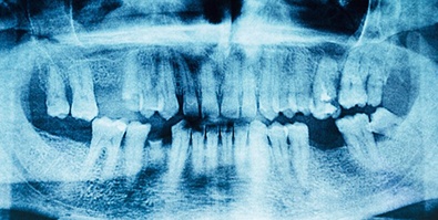 an X-ray depicting a patient’s missing teeth