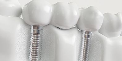 a 3D illustration of a dental implant bridge