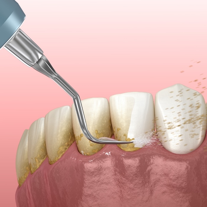 Animated dental tool removing plaque from teeth during scaling and root planing