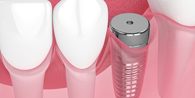 Digital illustration of a dental implant