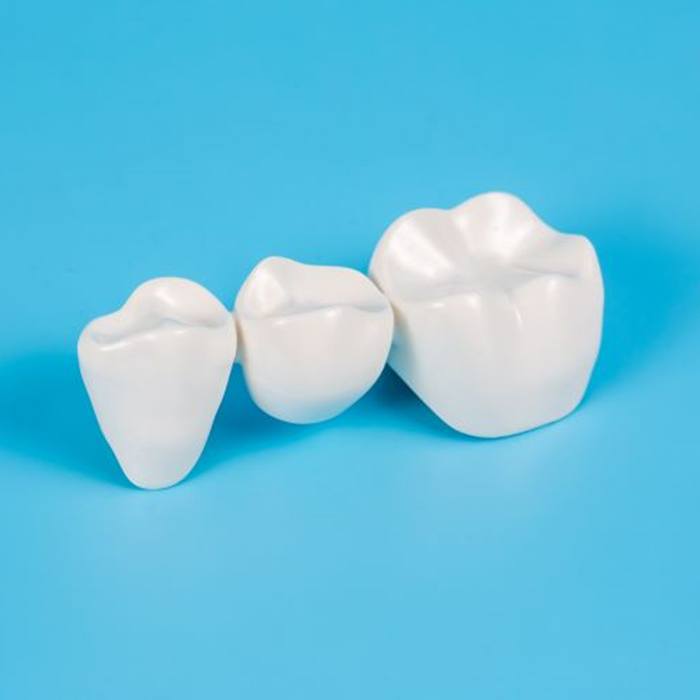 Three-unit dental bridge against blue background