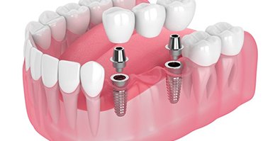 Illustration of dental implant bridge