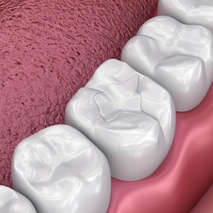 Animated row of teeth with dental sealants