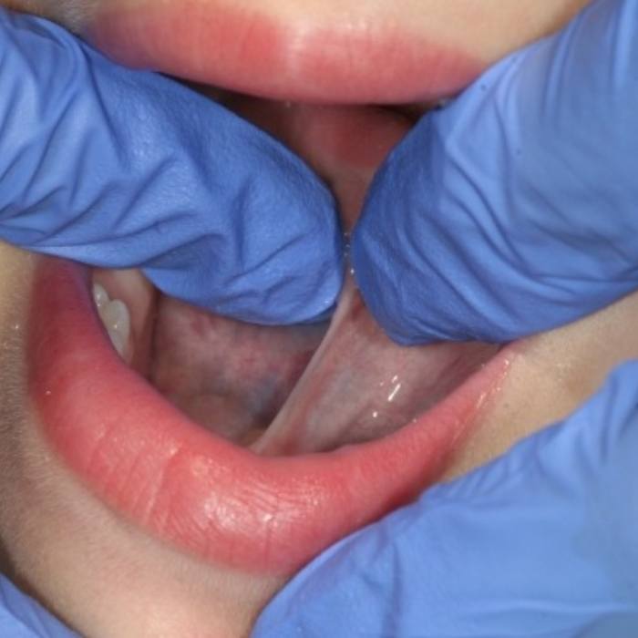 Children's dentist performing lip and tongue tie treatment