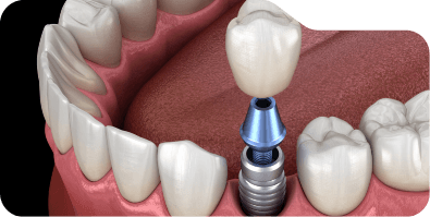 Animated dental implant with dental crown