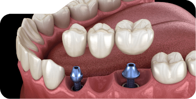 Two animated dental implants with dental bridge