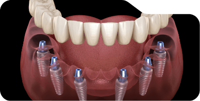Six animated dental implants with full implant denture