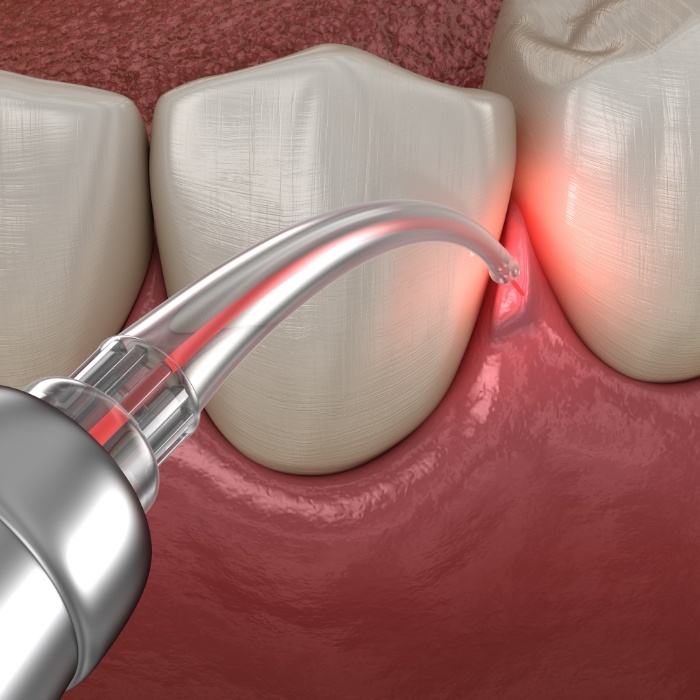 Animated soft tissue laser treating gum disease