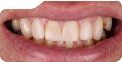 Close up of flawless teeth after treatment from Grand Prairie dentist