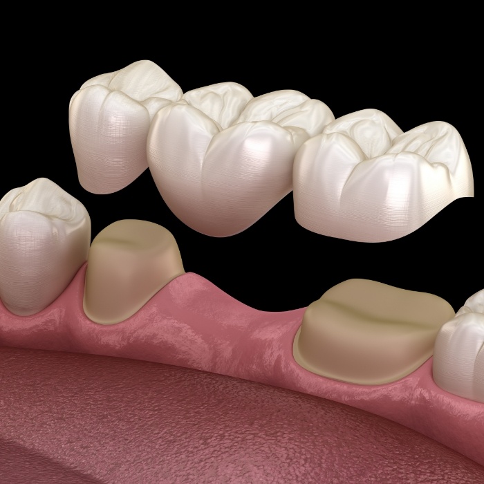 Animated dental bridge replacing a missing tooth