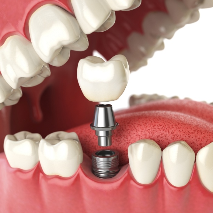 Animated dental implant replacing a missing tooth