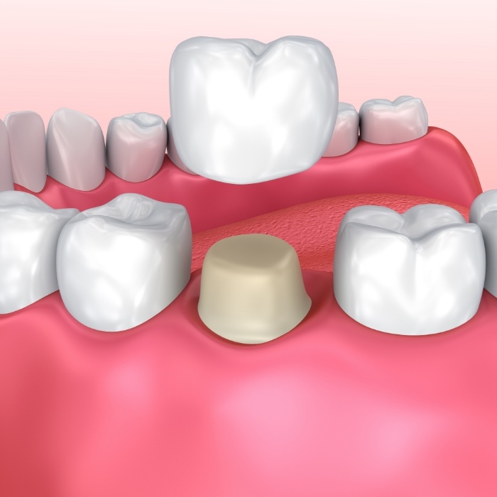 Animated dental crown being placed over tooth