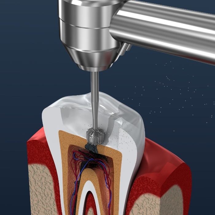 Animated diagram of root canal treatment process