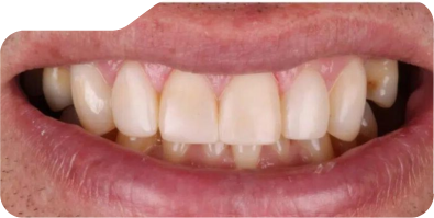 Closed up of flawless teeth after dental treatment