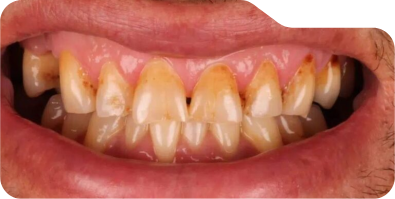 Close up of discolored teeth after treatment from Grand Prairie dentist