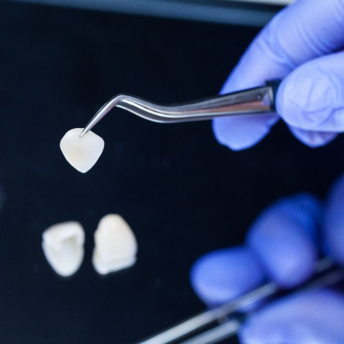 Dentist holding veneer with tweezers