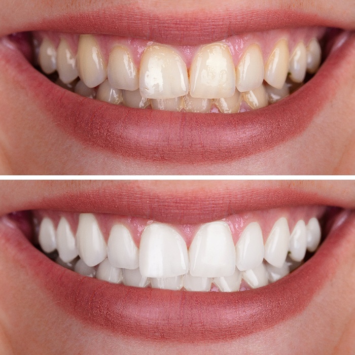 Closeup of patient's smile before and after teeth whitening treatment