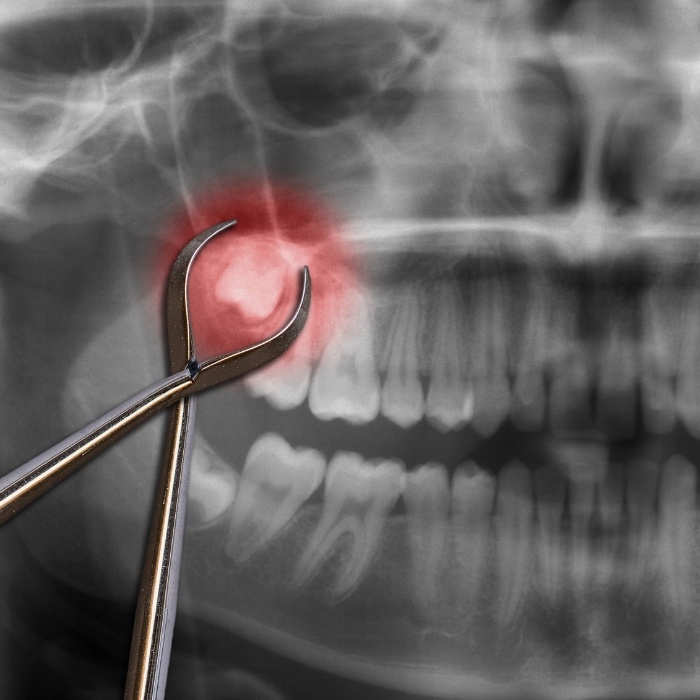 Dental forceps in front of x ray with impacted wisdom tooth highlighted red