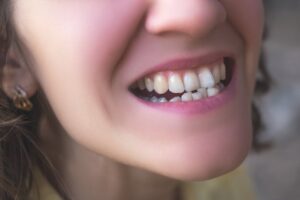 Woman with overcrowded teeth